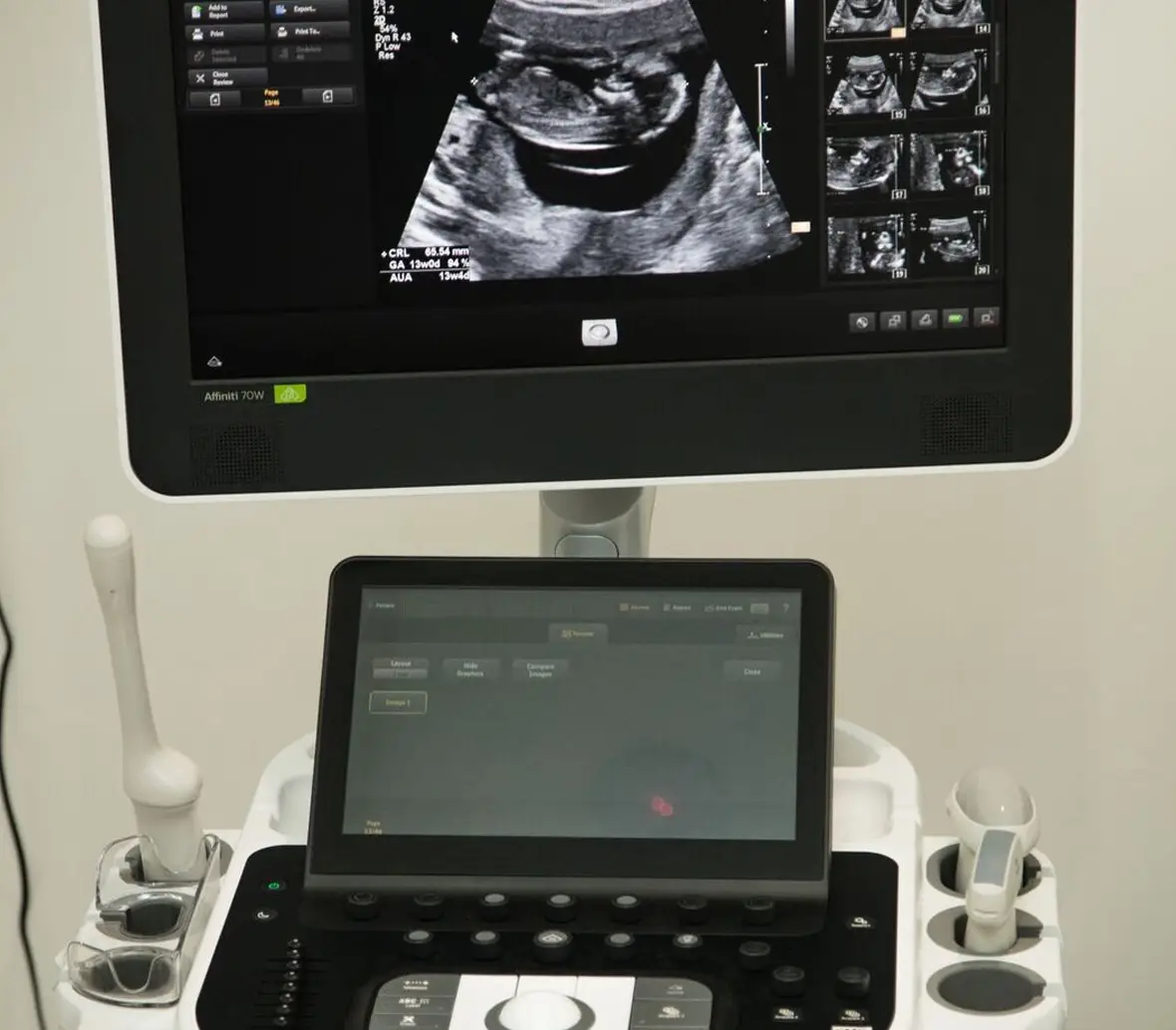 prenatal_img2 advanced imaging and ultrasound equipment | obstetric ultrasound near me