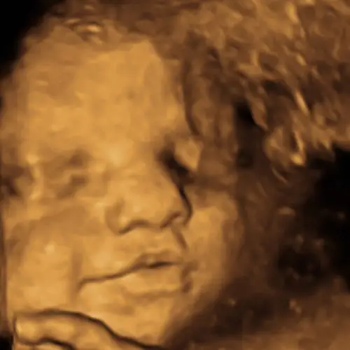 3D ultrasound image of a fetus | obstetric ultrasound near me
